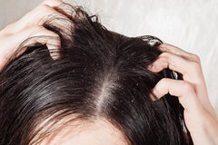 Why I am having dandruff?